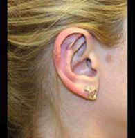Columbia Facial Plastic Surgery - The use of #gauge earrings causes  #earlobe #defects and, at times, significant contour distortion. The  challenge to this #otoplasty is to preserve enough tissue to recreate the